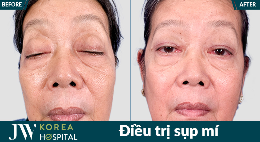 kết quả trước và sau khi điều trị sụp mi của khách hàng Bệnh viện JW