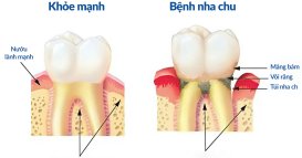 Bệnh nha chu – Những điều cần biết và cách điều trị hiệu quả