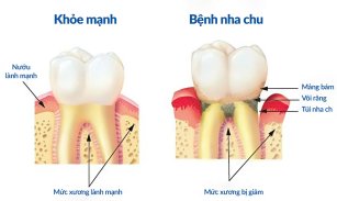 Bệnh nha chu – Những điều cần biết và cách điều trị hiệu quả