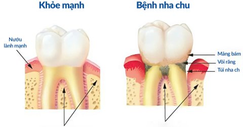 Bệnh nha chu – Những điều cần biết và cách điều trị hiệu quả