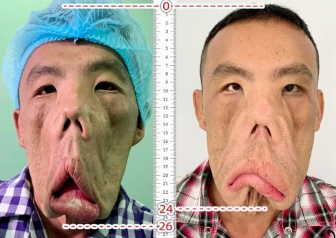 ANH MẾN ĐƯỢC “THU GỌN 2CM KHUÔN MẶT”