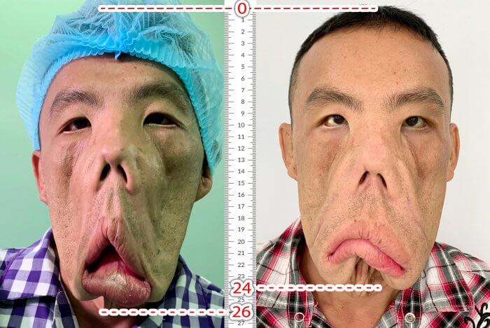 ANH MẾN ĐƯỢC “THU GỌN 2CM KHUÔN MẶT”