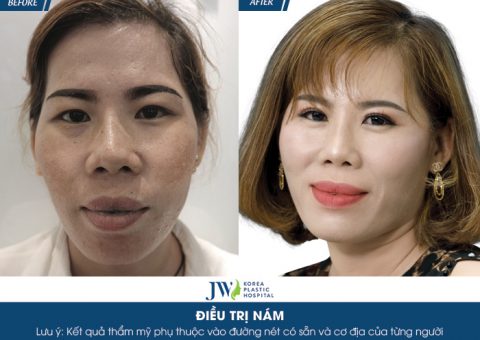 Diễn viên Lê Bê La xót xa trước làn da nám nặng của người phụ nữ 4 năm dùng kem trộn