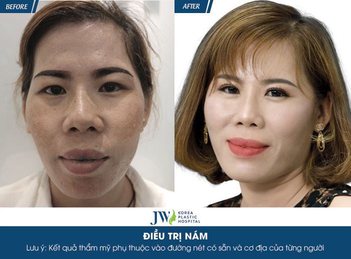 Diễn viên Lê Bê La xót xa trước làn da nám nặng của người phụ nữ 4 năm dùng kem trộn