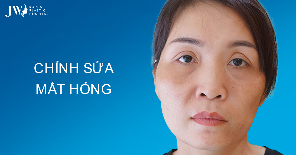 Chỉnh sửa mắt hỏng cứu cánh những đôi mắt dị tật do spa