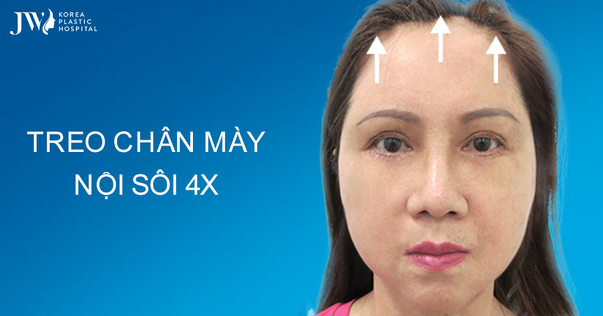Treo chân mày nội soi 4X cải thiện nếp nhăn lão hoá mắt