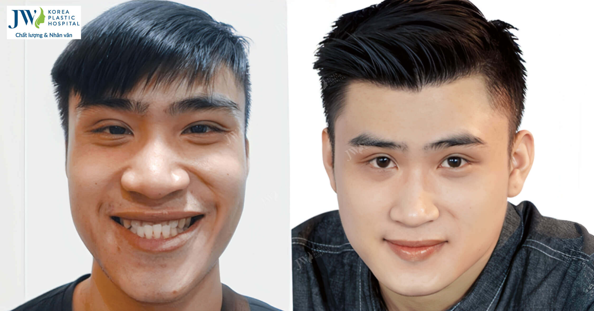Lần đầu Ca sĩ Hoàng Anh công khai diện mạo khi chưa phẫu thuật thẩm mỹ