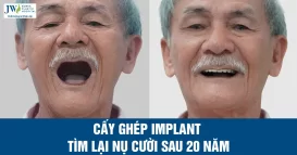 cay-ghep-implant-20-nam-1200x628px