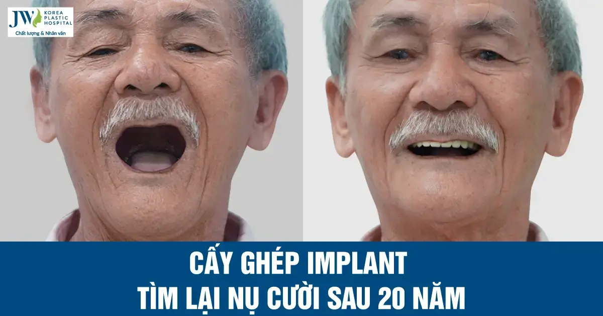 Cấy ghép implant giúp cựu chiến binh tìm lại nụ cười sau hơn 20 năm