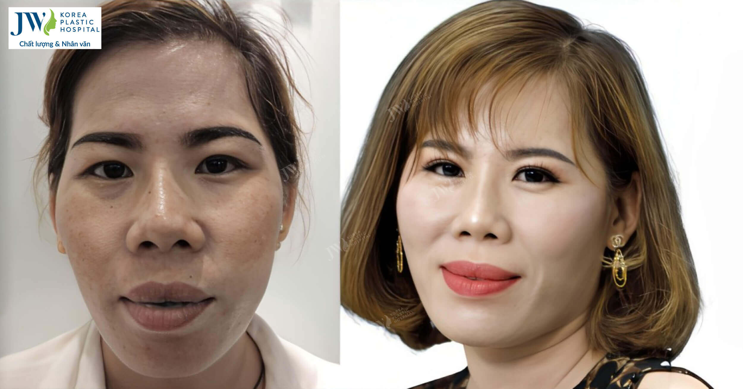 Người phụ nữ An Giang được “tái sinh” sau liệu trình trị nám do dùng kem trộn
