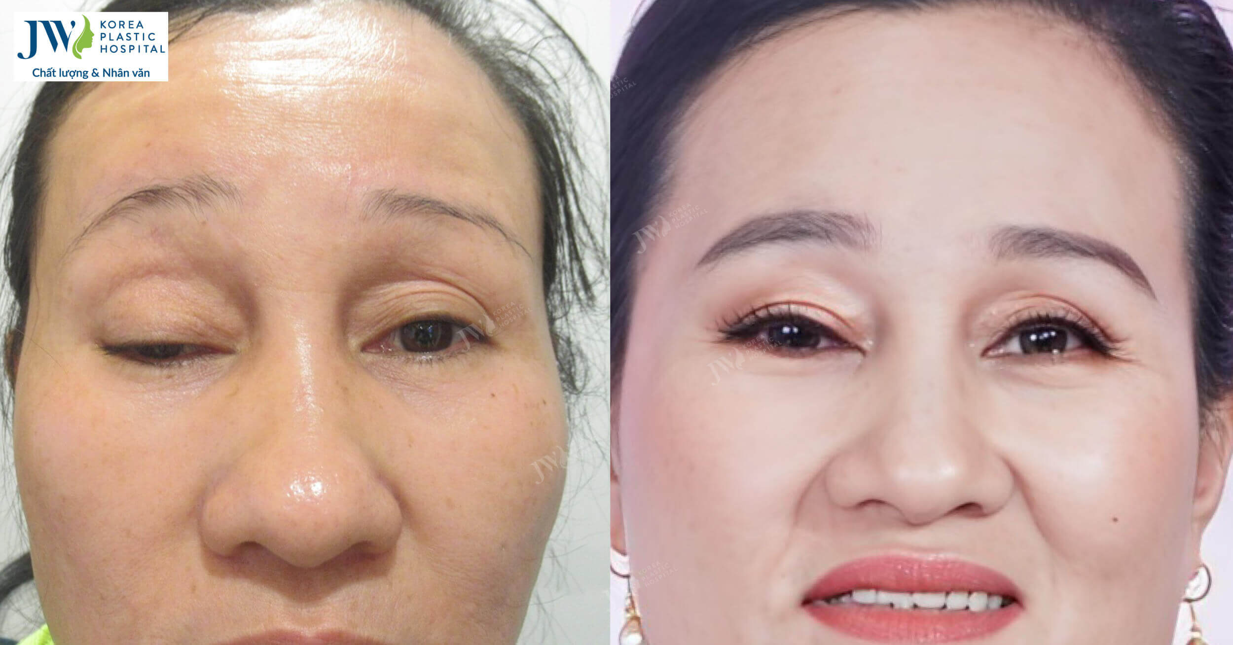 Giải cứu đôi mắt sụp mi bẩm sinh 48 năm