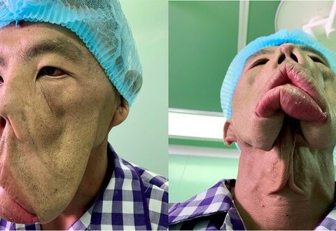 Bác sĩ Tú Dung lần đầu tiết lộ phác đồ điều trị cho anh Mến