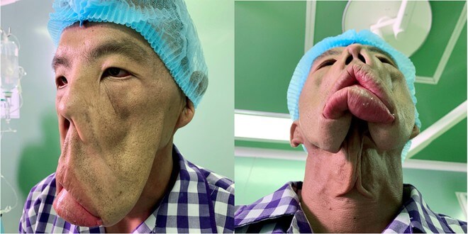 Bác sĩ Tú Dung lần đầu tiết lộ phác đồ điều trị cho anh Mến