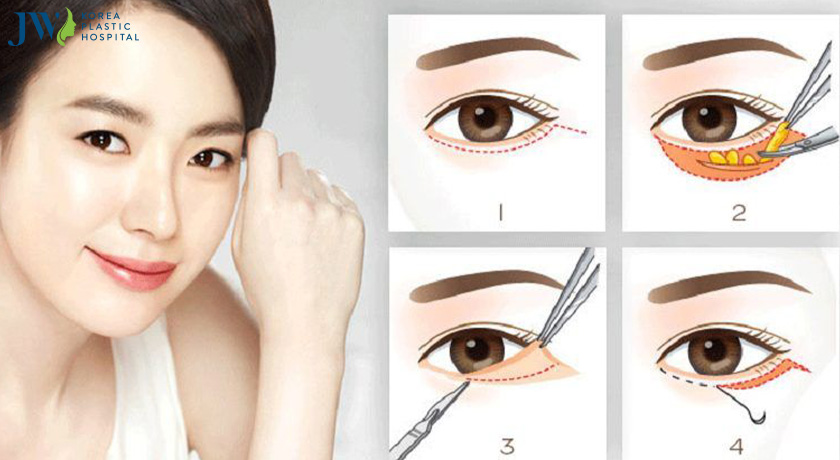 phương pháp chỉnh sửa mắt hỏng