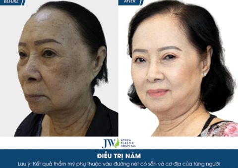 Ca sĩ Đông Quân phát cuồng với làn da đẹp của người phụ nữ U75 sau trị nám
