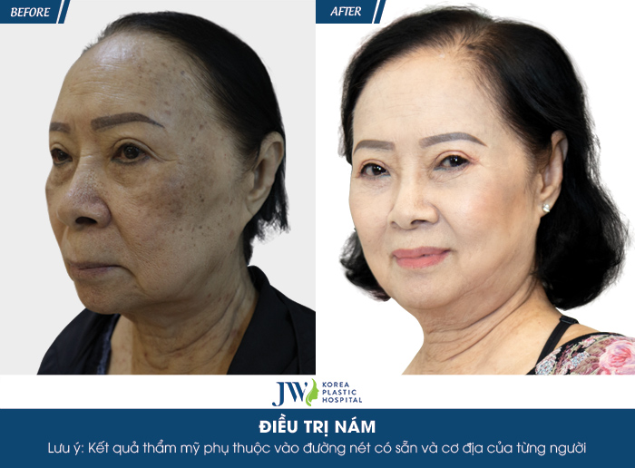 Ca sĩ Đông Quân phát cuồng với làn da đẹp của người phụ nữ U75 sau trị nám