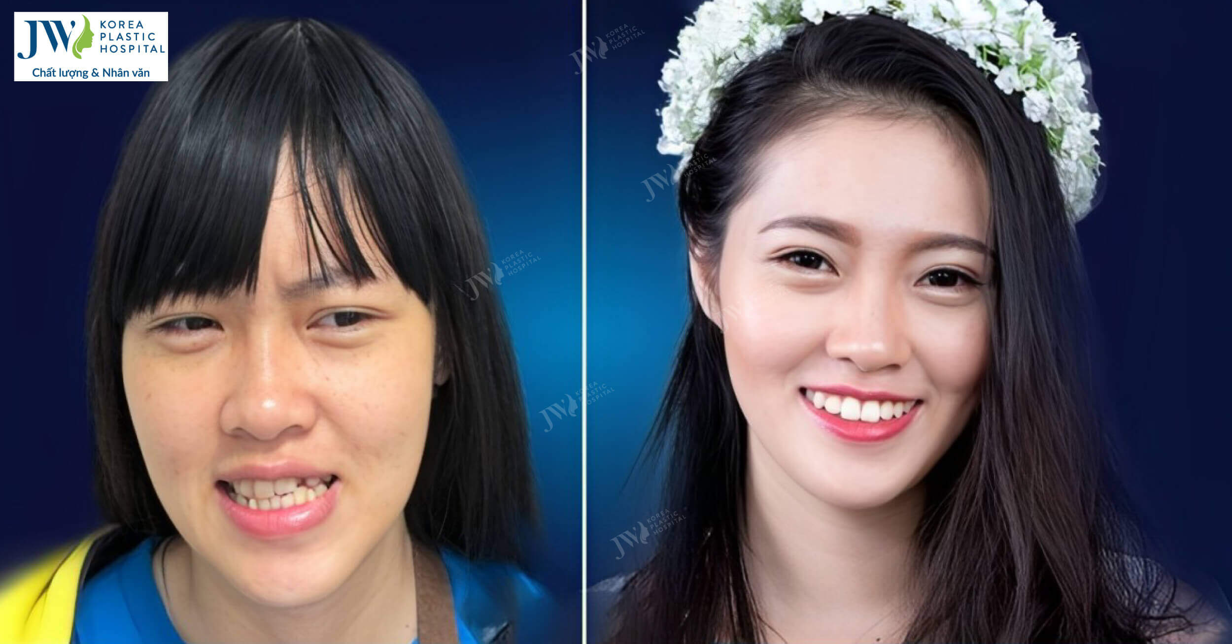 Đạo diễn Công Ninh ngạc nhiên trước nhan sắc của cô gái mặt lệch sau phẫu thuật