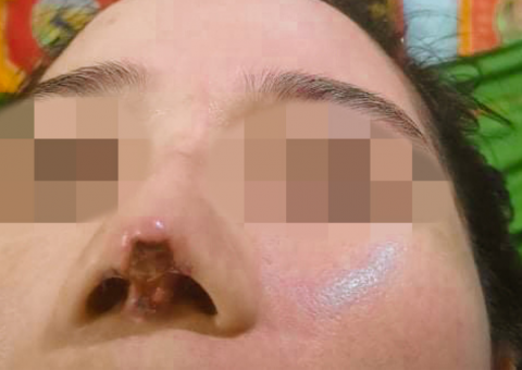 Lại một cô gái bị thối rữa mũi do nâng sụn dởm ở spa chui