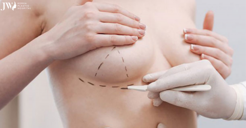 Điểm danh các phương pháp nâng ngực cho từng đối tượng