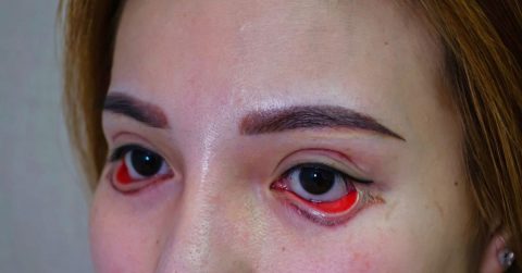 Rùng mình với ca cắt mí lỗi được Bác sĩ Tú Dung cấp cứu kịp thời
