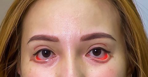 Xót xa cô gái 25 tuổi Bến Tre mang đôi mắt quỷ sau cắt mí mắt ở Thẩm mỹ viện tà đạo