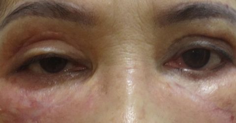 Sụn mũi xuyên trán, đầu mũi xì dịch, mắt trợn thâm tím đen vì spa ghép da man rợ