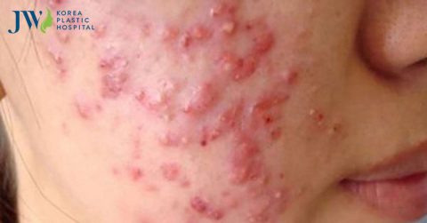 Phát ban mụn trứng cá: nguy hiểm nếu không điều trị kịp thời