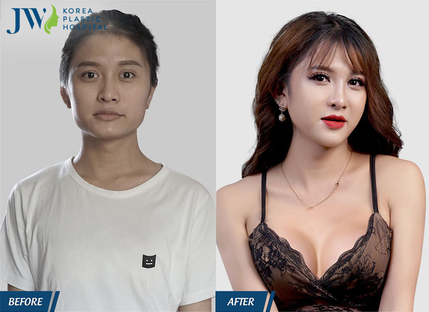 Nàng hot girl Kim Tiền sau khi phẫu thuật nâng ngực