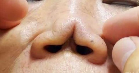 Những ca phẫu thuật thẩm mỹ nâng mũi hỏng được Bệnh viện JW chữa lành