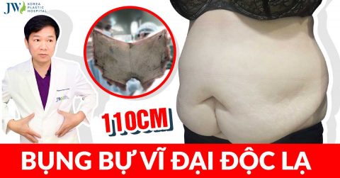 Cắt mỡ tạo hình thành bụng an toàn với 3 nguyên tắc vàng
