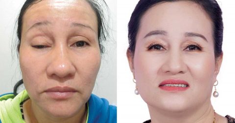 Mắt đẹp tự nhiên sau phẫu thuật nâng cơ mí mắt