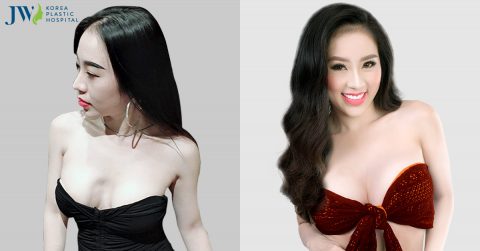Thẩm mỹ vòng 1 tại Bệnh viện JW: sở hữu ngực đẹp lý tưởng không khó