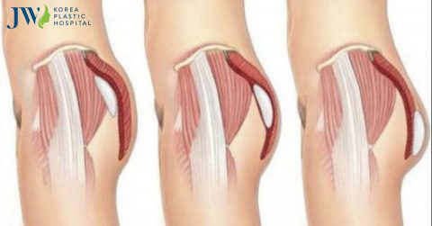 Phẫu thuật mông hóp: tái tạo vòng 3 hoàn mỹ quyến rũ