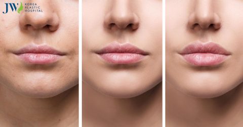Phẫu thuật thẩm mỹ môi dày cho nàng thích môi quyến rũ kiểu Tây