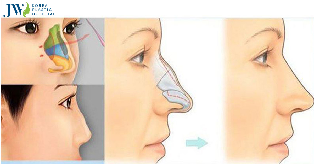 Bệnh viện nâng mũi uy tín vạn người mê tại TP.HCM