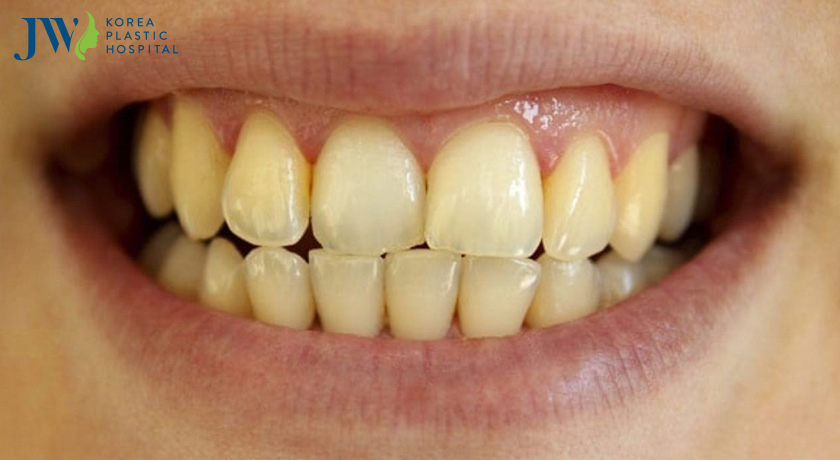 Cách làm trắng răng bị ố vàng?