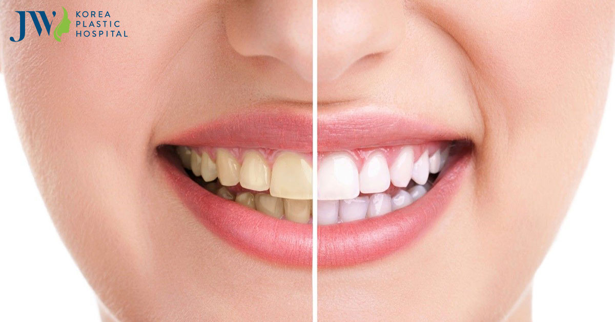 Cách làm trắng răng bị ố vàng tại nhà nhanh chóng tức thì