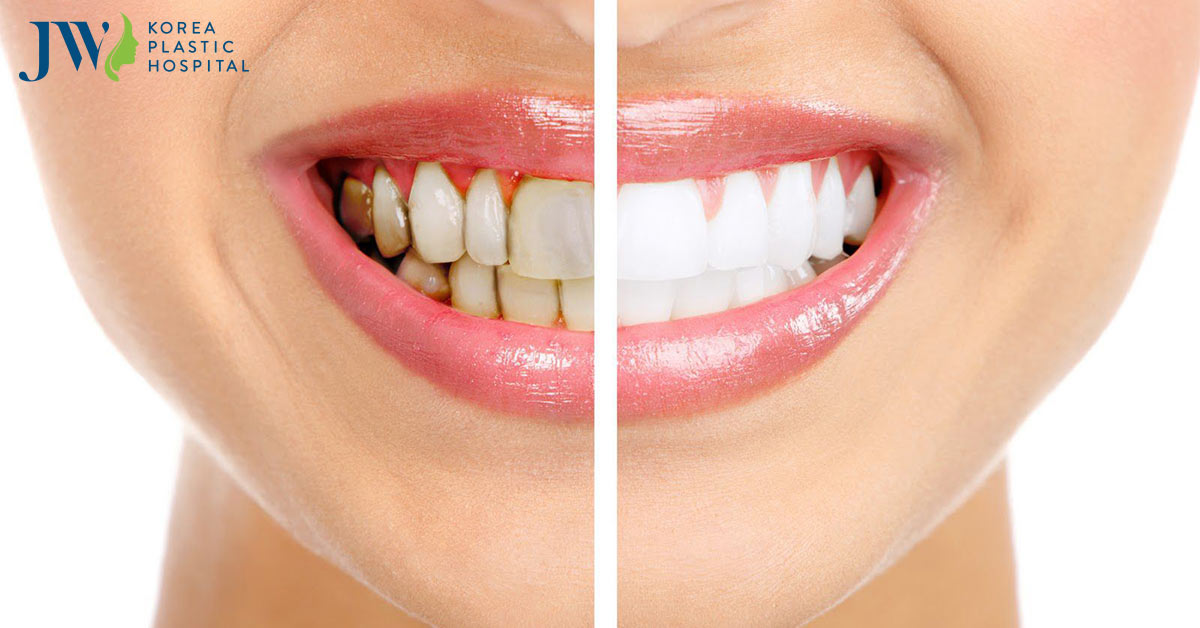 Lấy cao răng tại nhà hiệu quả nhanh loại bỏ ố vàng chỉ trong vài phút