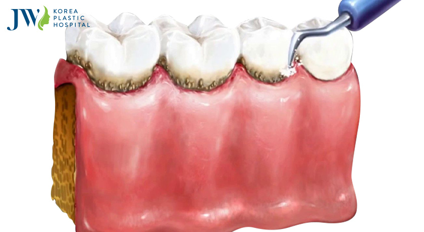 Cách lấy cao răng tại nhà không cần đi đến phòng nha