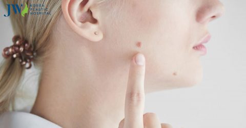 Tẩy nốt ruồi tại nhà nhanh chóng dứt điểm như điều trị ở spa