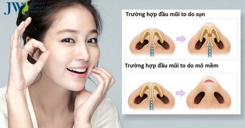 Bí kíp xóa nếp nhăn rãnh mũi má không cần phẫu thuật thẩm mỹ