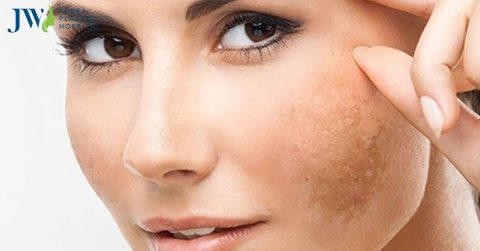Cách trị nám da tại nhà bằng các phương pháp cực kì dễ thực hiện