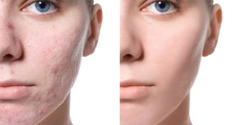 Cách trị sẹo rỗ, lõm lâu năm ngay tại nhà đơn giản và hiệu quả