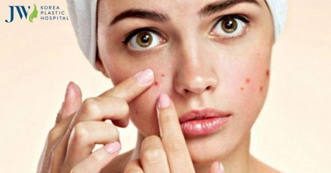 Cách trị mụn bằng mật ong an toàn hiệu cao ngay tại nhà