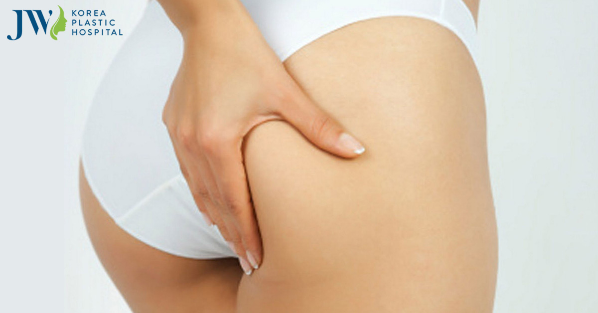 Cách trị thâm mông tự nhiên tại nhà nhanh chóng và hiệu quả
