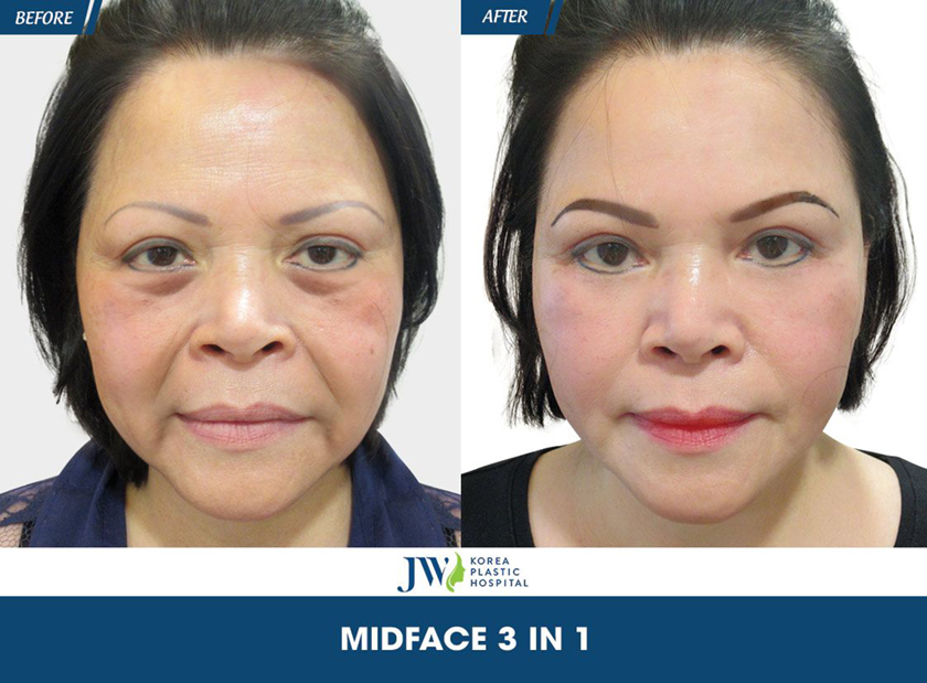 Ưu điểm của trẻ hóa khuôn mặt Midface 3 in 1