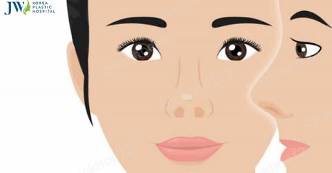 Mũi hếch là gì? Vận mệnh người mũi hếch thế nào? Làm sao khắc phục?