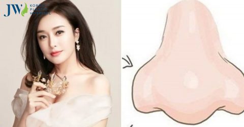 Mũi lân, mũi sư tử là gì? Có nên sửa hay không? Nên sửa ở đâu?