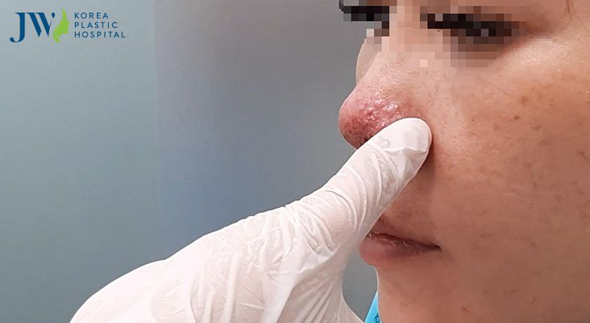 Những hiện tượng sau khi nâng mũi thường gặp
