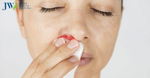 Nâng mũi bị chảy máu do đâu? Cách ngăn ngừa chảy máu sau nâng mũi